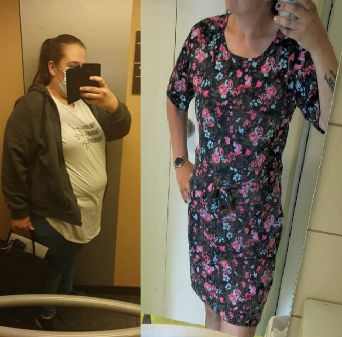 Voor en na foto van Kimberly, die aanzienlijk gewicht verloor na een maagverkleining bij WeightWorks